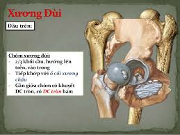Chỏm xương đùi dẹt - Hình ảnh minh họa